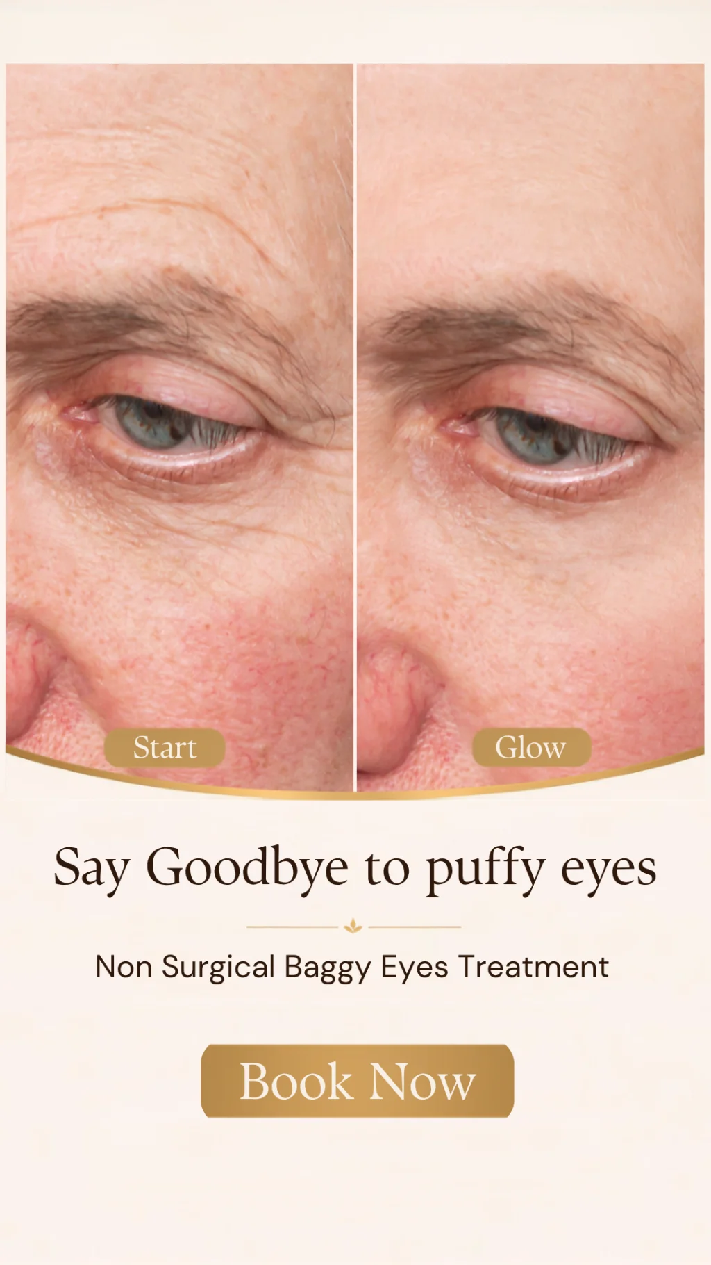 Med spa ad creative showing a non surgical baggy eyes treatment before and after