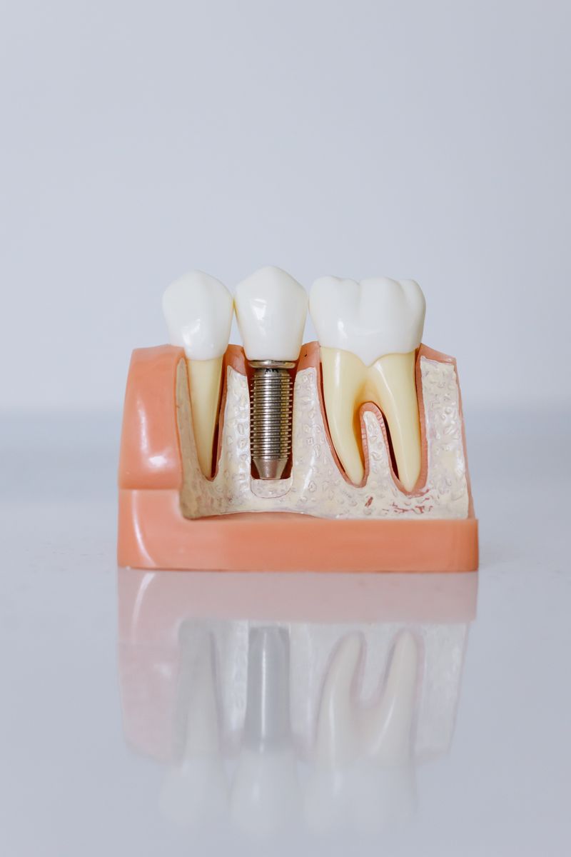 Close-up of a dental implant model
